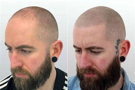 scalp micropigmentation regret|Scalp Micropigmentation 101: Pros, Cons, Cost, and .